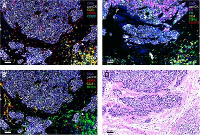 The Immunology of Hormone Receptor Positive Breast Cancer